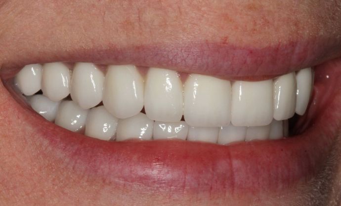 Full Mouth Rehabilitation: Full mouth Rehabilitation: Tetracycline Staining, Implants and Broken Teeth - After