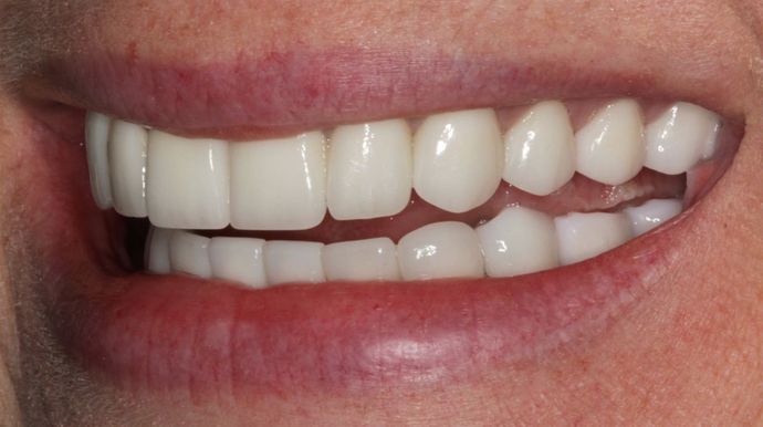 Full Mouth Rehabilitation: Full mouth Rehabilitation: Tetracycline Staining, Implants and Broken Teeth - After