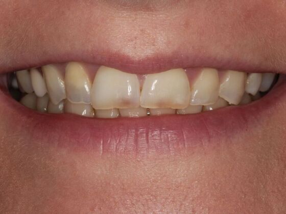 Full Mouth Rehabilitation Case 7 - Before