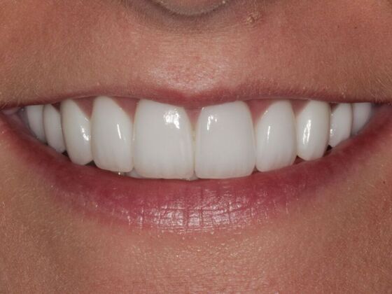 Full Mouth Rehabilitation Case 7 - After