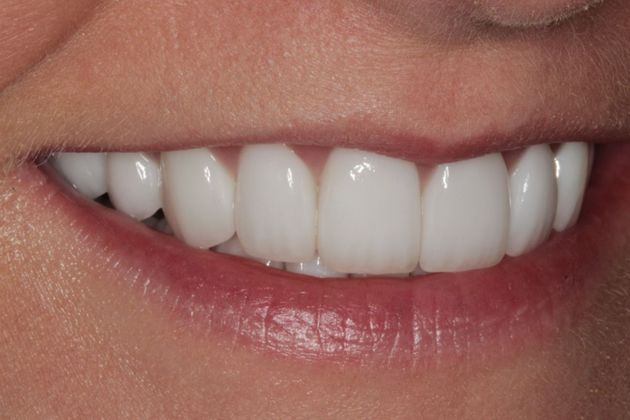 Full Mouth Rehabilitation: Full mouth Rehabilitation for Bulimia, eating disorder - After