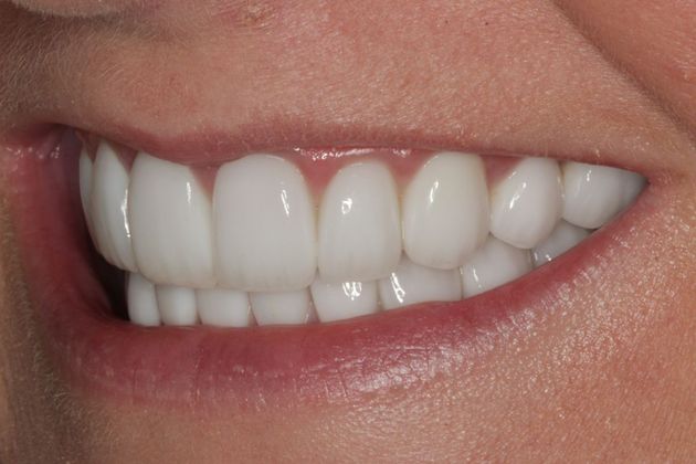 Full Mouth Rehabilitation: Full mouth Rehabilitation for Bulimia, eating disorder - After