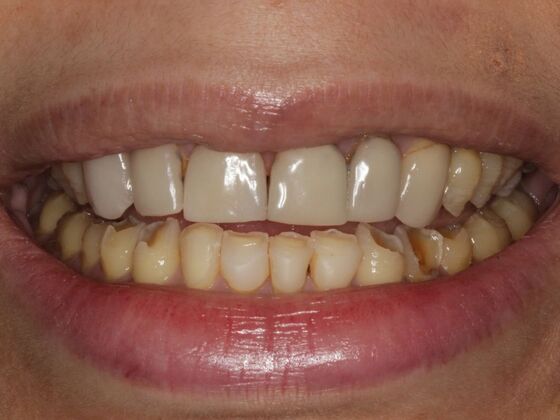 Full Mouth Rehabilitation Case 8 - Before