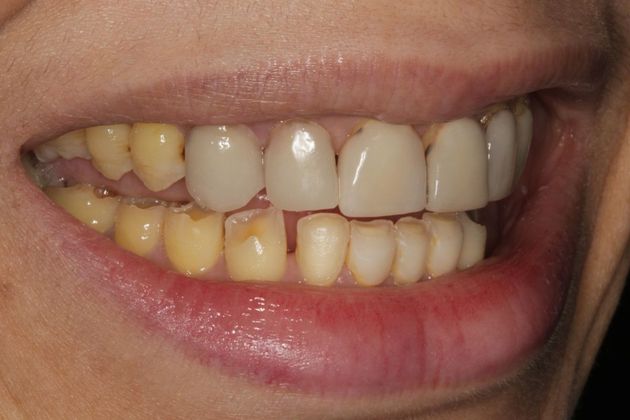 severe translucent teeth