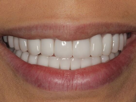 Full Mouth Rehabilitation Case 8 - After
