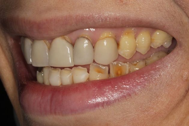 Full Mouth Rehabilitation: Severe Tooth Erosion - Before