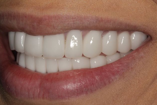 Full Mouth Rehabilitation: Severe Tooth Erosion - After