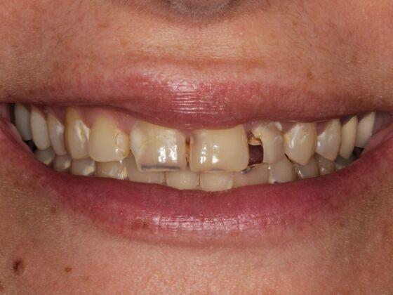 Full Mouth Rehabilitation Case 9 - Before