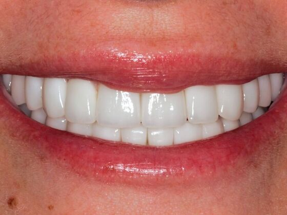 Full Mouth Rehabilitation Case 9 - After