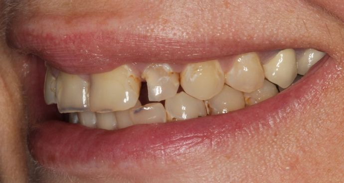 severe-decay-from-dry-mouth-restored-with-full-mouth-rehabilitation