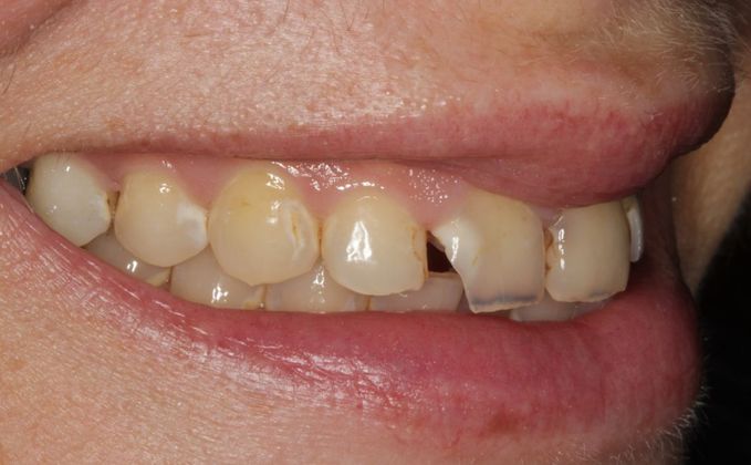 severe-decay-from-dry-mouth-restored-with-full-mouth-rehabilitation