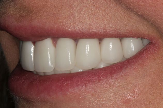 Full Mouth Rehabilitation: Severe Decay from dry mouth restored with Full Mouth Rehabilitation - After