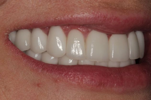 Full Mouth Rehabilitation: Severe Decay from dry mouth restored with Full Mouth Rehabilitation - After