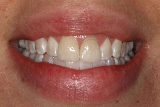 Cosmetic Dentistry "White Spots", mottled tooth enamel - Before