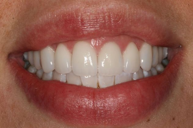Cosmetic Dentistry "White Spots", mottled tooth enamel - After