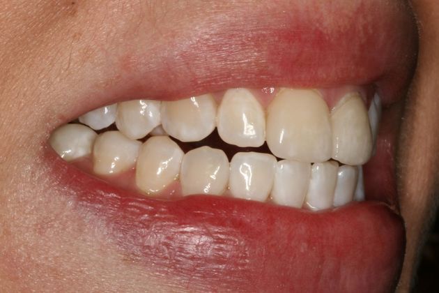 "White Spots", mottled tooth enamel - Cosmetic Dentistry ...