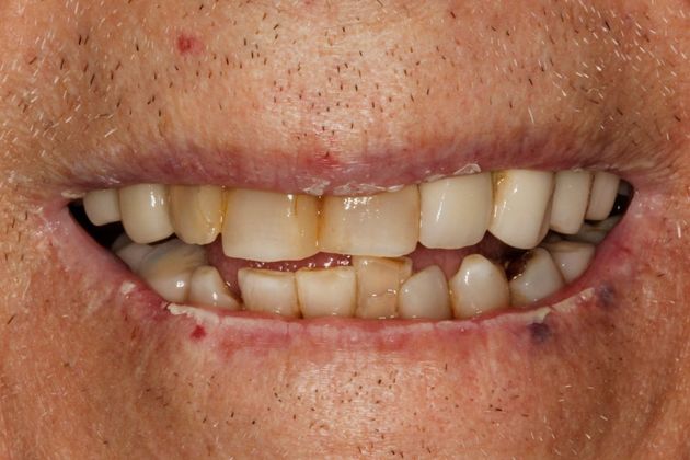 Dental Implants Esteem Dental Implant Temporary Bridge - Before