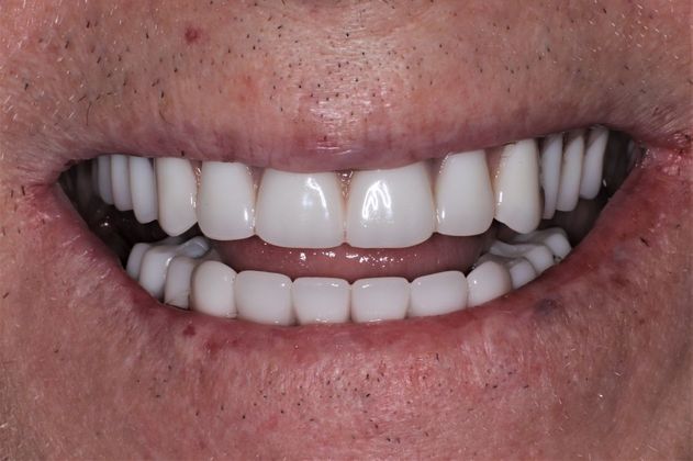 Dental Implants Esteem Dental Implant Temporary Bridge - After