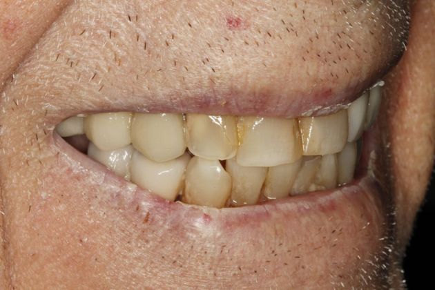 Dental Implants: Esteem Dental Implant Temporary Bridge - Before