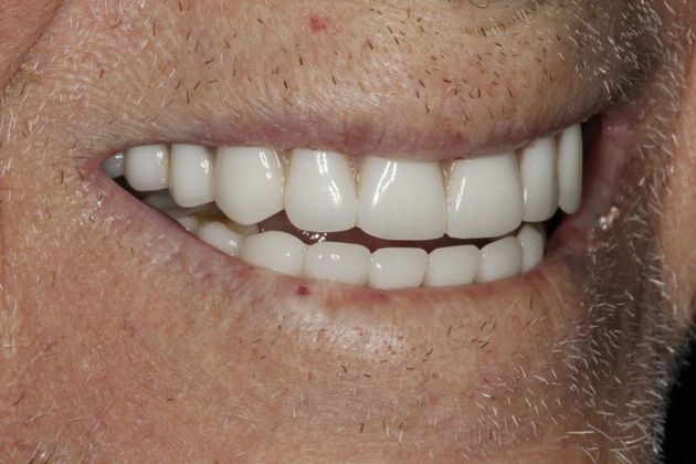Dental Implants: Esteem Dental Implant Temporary Bridge - After