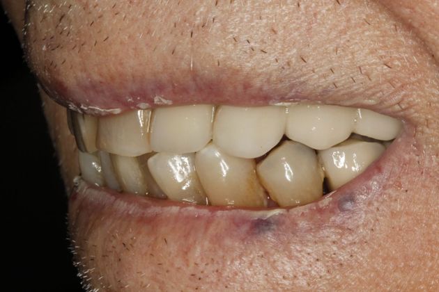 Dental Implants: Esteem Dental Implant Temporary Bridge - Before