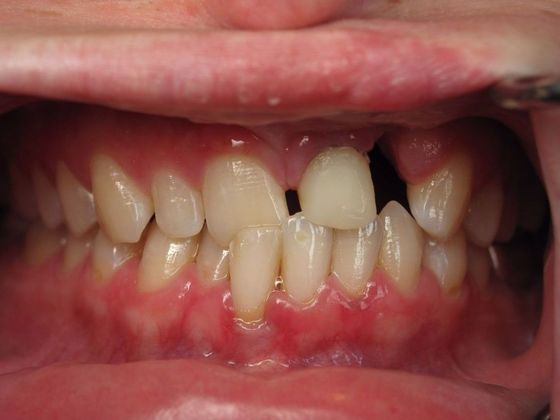 Cosmetic Crowns Case 4 - Before