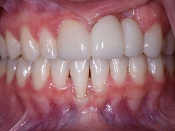Cosmetic Crowns Case 4 - After