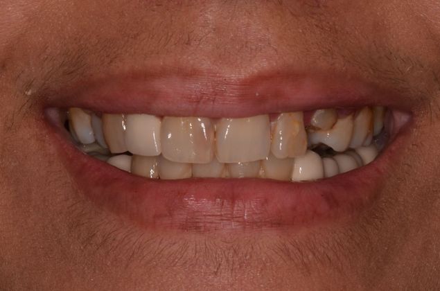 Dental Implants Case 28 - Before