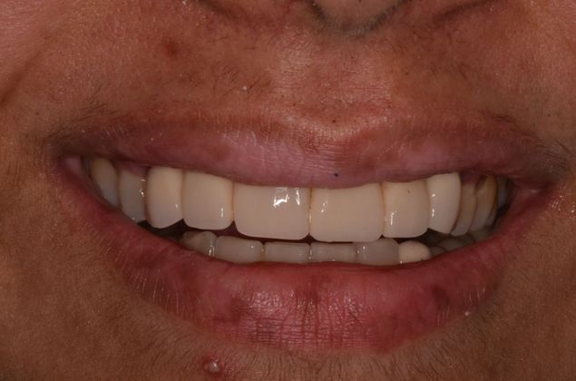 Dental Implants Case 28 - After