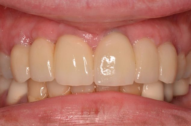 Dental Implants: Case 28 - After