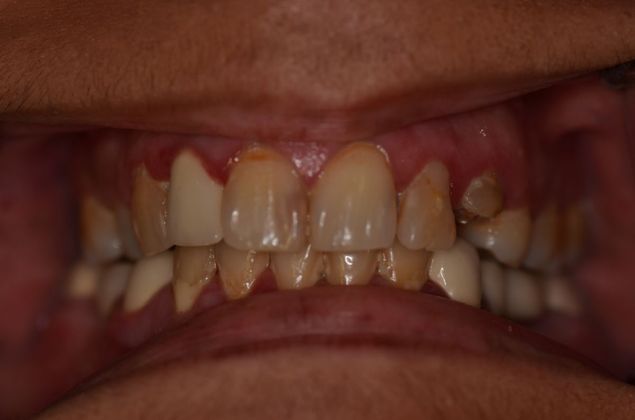 Dental Implants: Case 28 - Before