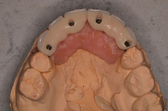Bridges: Case 3 - Implants supported bridges on stone model