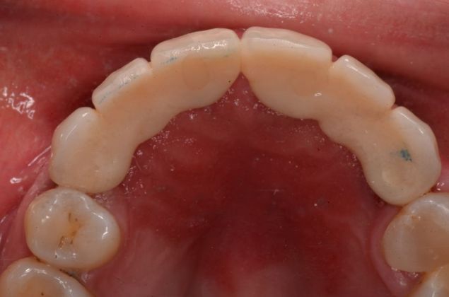 Bridges: Case 3 - After implant bridges on implants