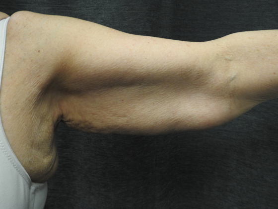 Arm Lift Case 4 - Before