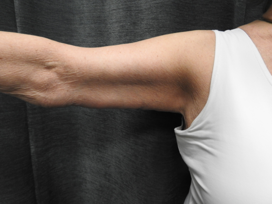 Arm Lift: Case 4 - After