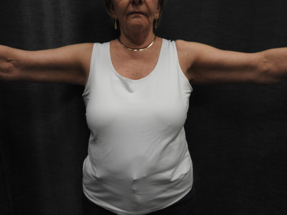 Arm Lift: Case 4 - After