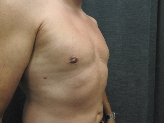 Breast Reduction Case 6 - After