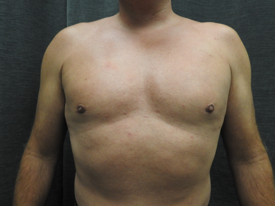 Breast Reduction: Case 6 - After