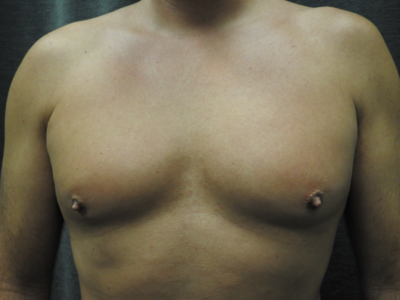 Breast Reduction: Case 6 - Before