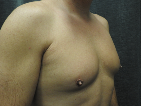 Breast Reduction Case 6 - Before