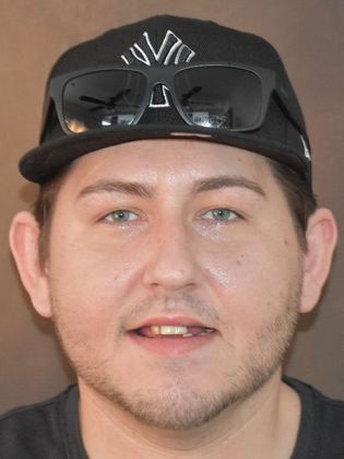 Prettau Zirconia Implant Bridge: Jeff - Before