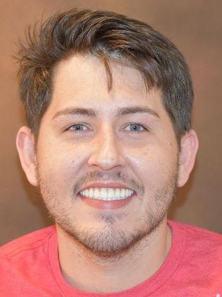 Prettau Zirconia Implant Bridge: Jeff - After