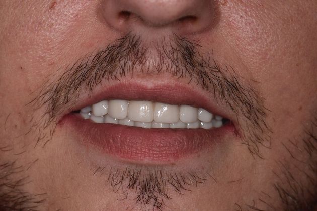 Prettau Zirconia Implant Bridge: Jeff - After