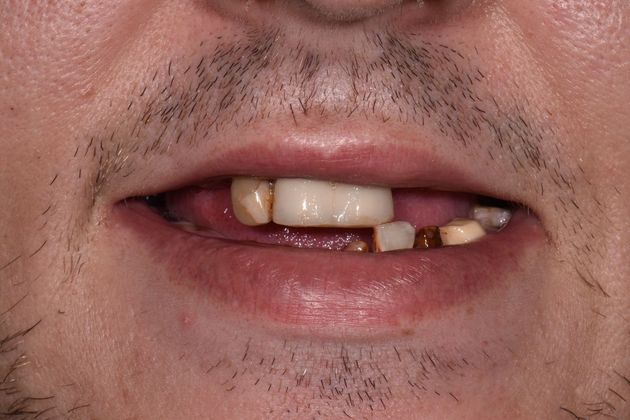 Prettau Zirconia Implant Bridge: Jeff - Before