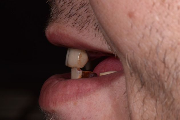 Prettau Zirconia Implant Bridge: Jeff - After