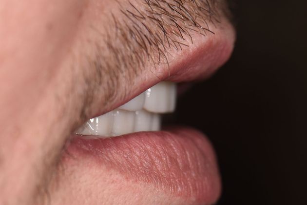 Prettau Zirconia Implant Bridge: Jeff - Before