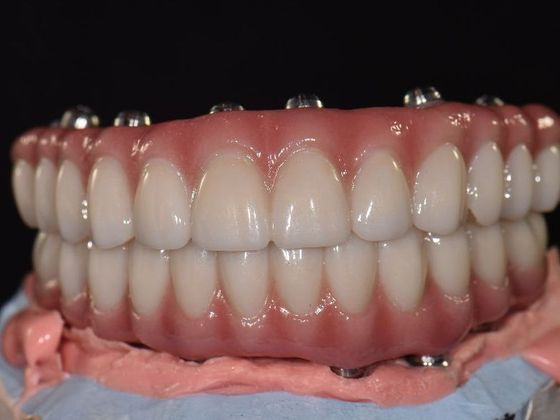 Prettau Zirconia Implant Bridge: Jeff - Before