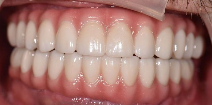 Prettau Zirconia Implant Bridge: Jeff - After