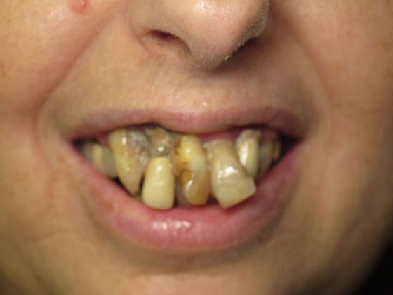 Prettau Zirconia Implant Bridge: Roslyn - Before