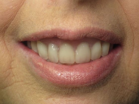 Prettau Zirconia Implant Bridge: Roslyn - After